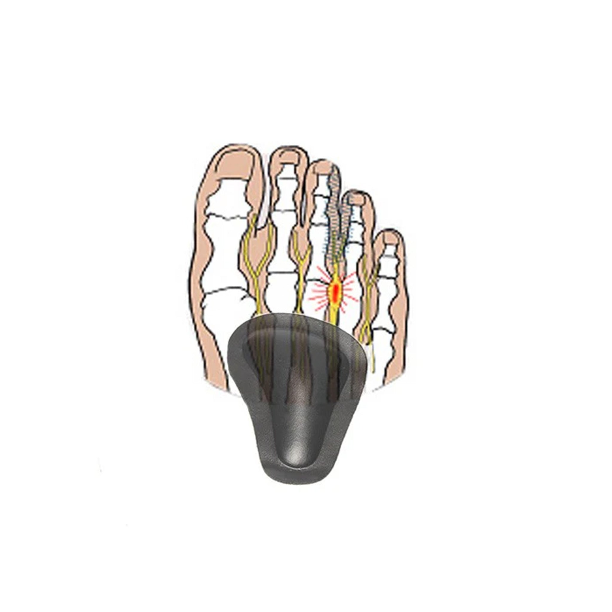 Self-adhesive pads for sunken forefoot arches