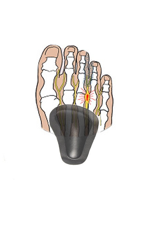 Self-adhesive pads for sunken forefoot arches