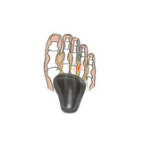 Self-adhesive pads for sunken forefoot arches