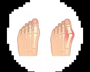 Hallux valgus fod Hallux valgus fod